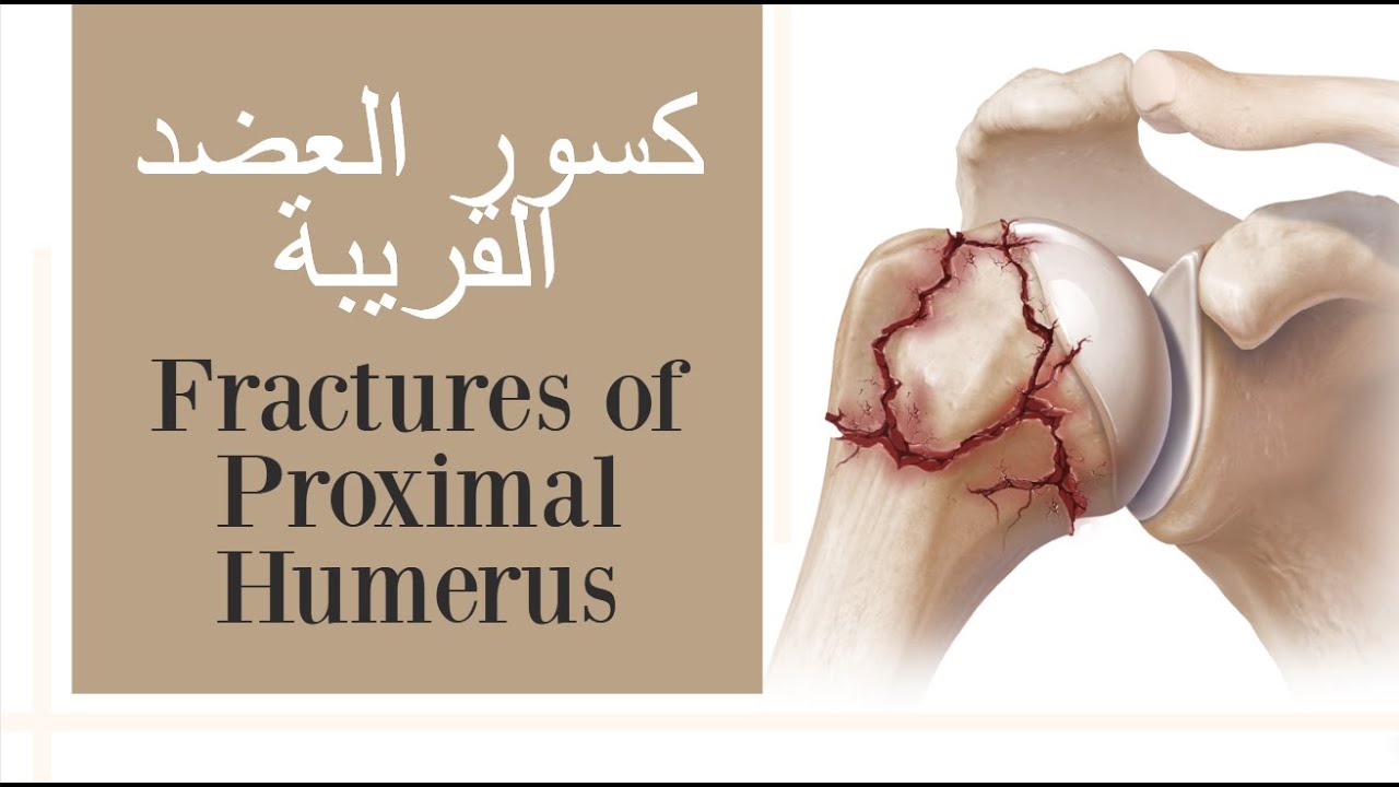 переломы проксимального отдела плечевой кости – сломанное плечо (с субтитрами)