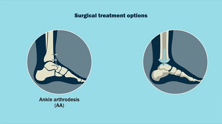 "Outcomes of Total Ankle Replacement Versus Ankle Arthrodesis for the Treatment of End-Stage Ankle A