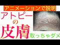 【5分で説明】アトピーや脱ステロイド中に出現する瘡蓋（かさぶた）や落屑（らくせつ）はとっちゃダメ！