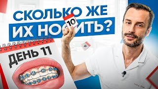 Сколько лет нужно носить брекеты и от чего это зависит? Современная ортодонтия