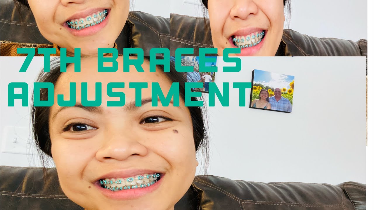 7th ADJUSTMENT BRACES MY BRACES JOURNEY YouTube