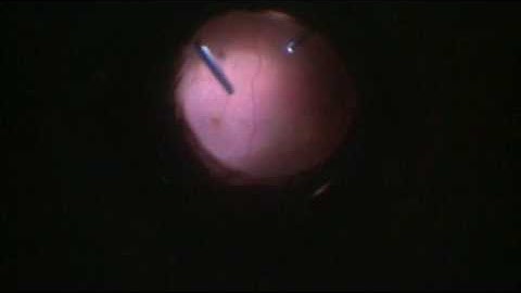 Retrieval of IOL off retina and double needle IOL exchange by Steven G. Safran MD