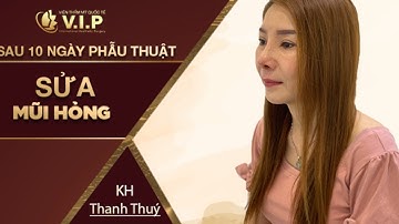 Sửa mũi hỏng Nâng mũi VIP – sự thay đổi kỳ diệu