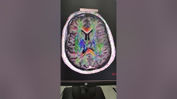 TRACTOGRAFIA RESSONANCIA MAGNÉTICA PHILIPS MULTIVA 1,5T