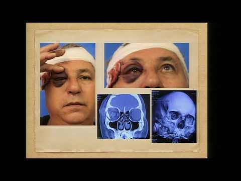 Video: Prijelom Kostiju U Gmazova - Slomljena Kost U Gmazu