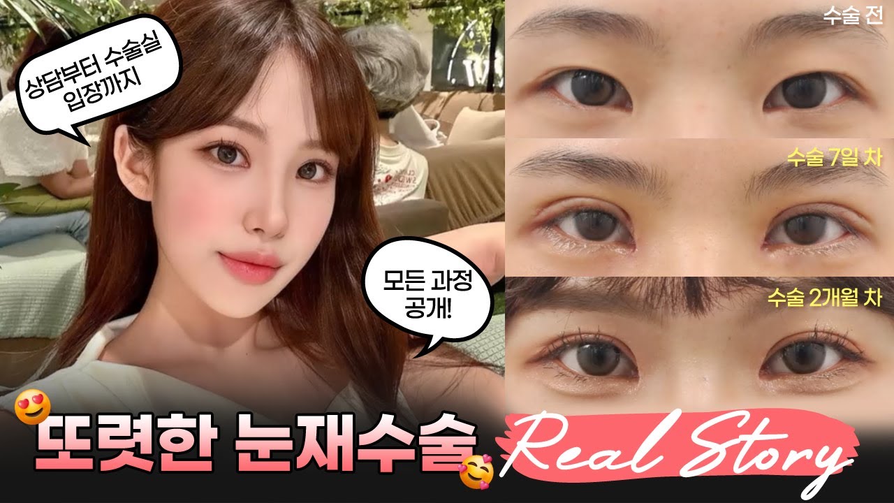 [奧樂整形外科診所] 👀 清晰有神的 #眼部重修手術 #術前術後 真實呈現~! | 從諮詢到進入手術室 全程公開! | 眼部重修手術 | 切開式雙眼皮 #real #really