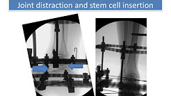 Subtalar Distraction for Treatment of Subtalar Joint Arthritis: Two Patients