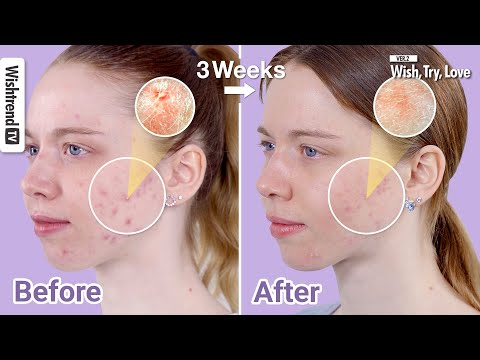 How to REALLY Treat Acne: 6 Major Tips to Keep Acne Under Control!ㅣWish, Try, Love