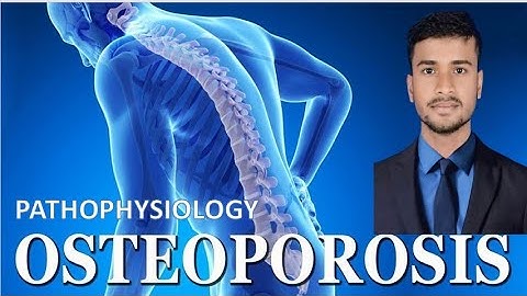 Osteoporosis | Pathophysiology | explained by Arun kumar dutta |