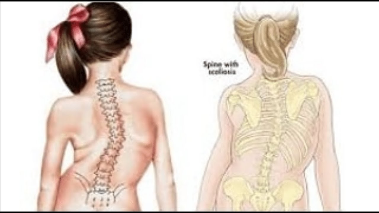 Д-р Ели Иванова за сколиозата