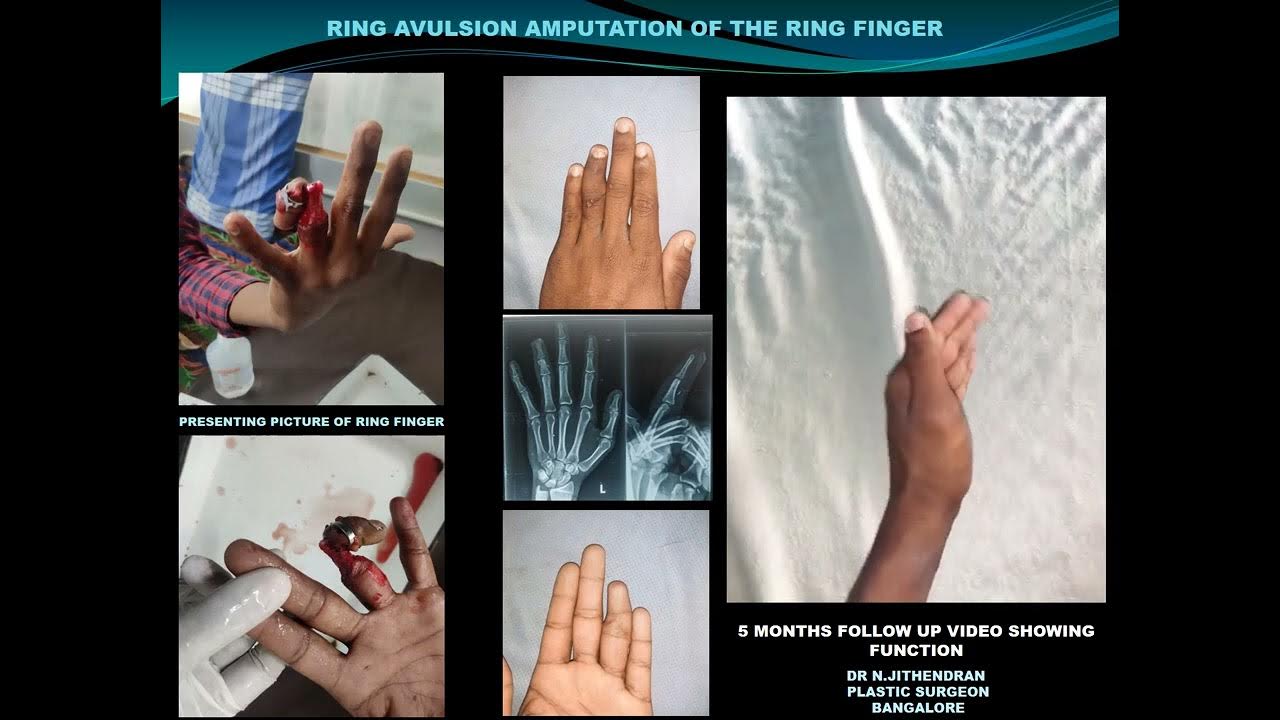 Ring Avulsion injury of ring finger YouTube