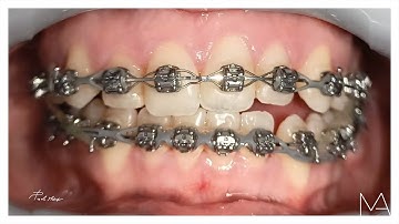 Dental Monitoring video morphing