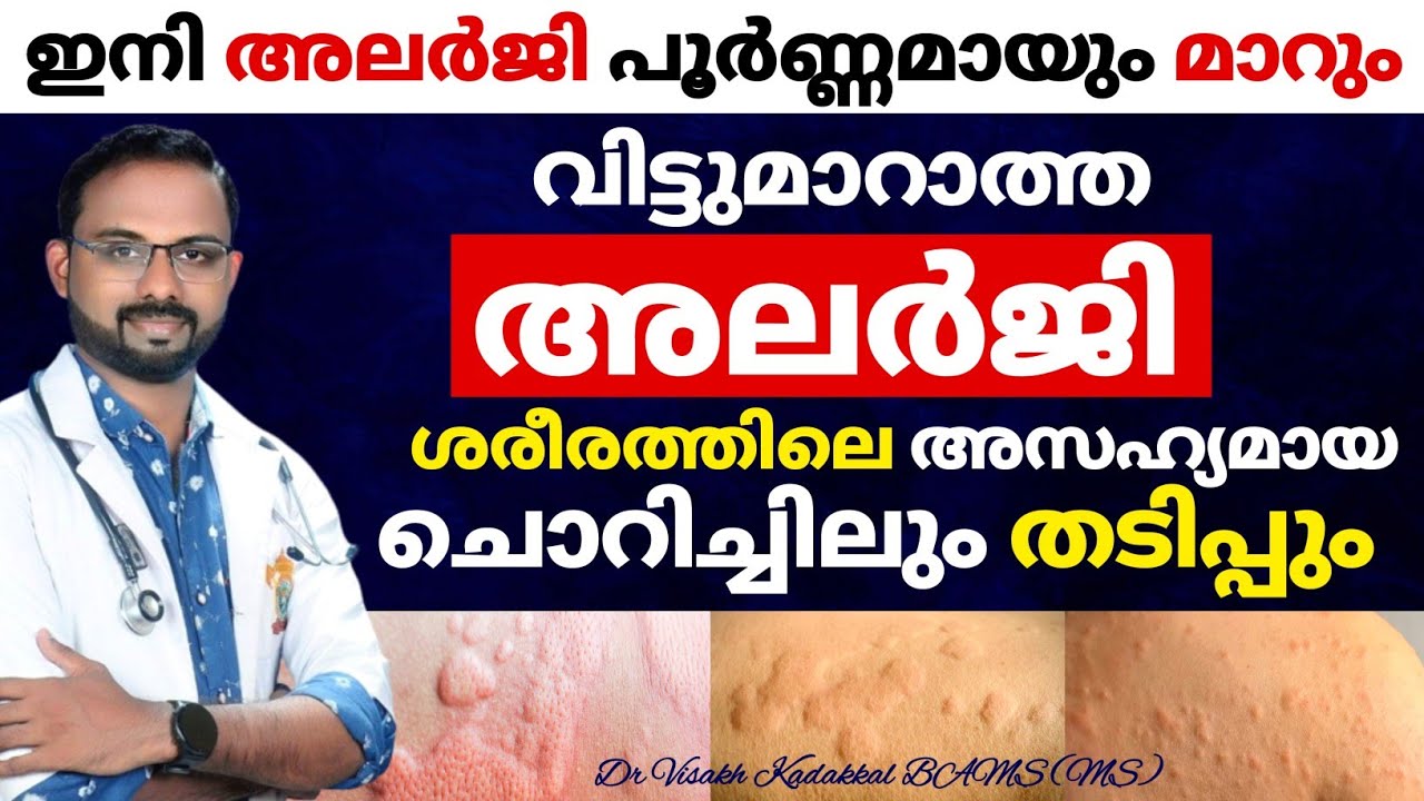 അലർജി പൂർണമായി മാറും ; എറ്റവും എളുപ്പ വഴി ഇതാണ് | How to get rid of allergy | Dr Visakh Kadakkal