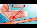 КАК ВЫЛЕЧИТЬ БОЛЬ В ЛОКТЕ? | Локтевой бурсит (Часть 2)