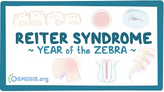 Reiter syndrome (Year of the Zebra)