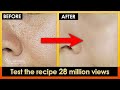 How to Get rid of Large Pores and Shrink pores. Get tighter &amp; smooth skin Naturally. (Work 100%)