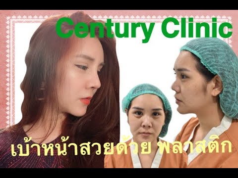 ห้างเซ็นจูรี่  2022  [Century Clinic ]เสริมจมูก จากหน้าหมวยเป็น ลูกครึ่ง. โดยหมอนก.  ที่นี่ที่เดียวจบ