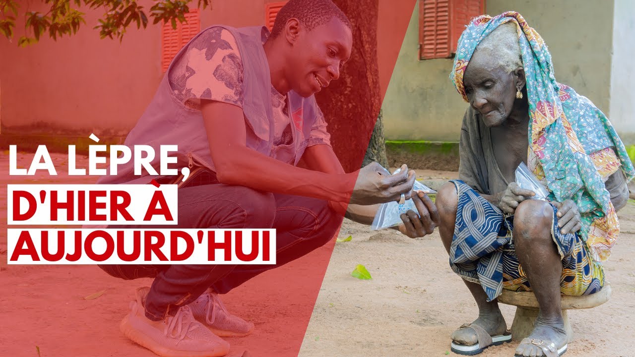 LES OUBLIÉS - La lèpre, d'hier à aujourd'hui.
