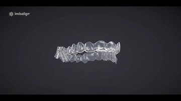 Invisalign Treatment With Mandibular Advancement