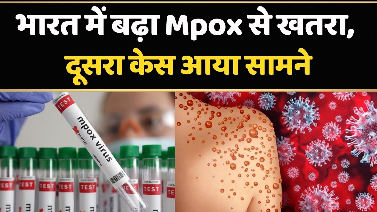 Mpox Virus: भारत में Monkeypox का दूसरा मामला | जानिए कितना हो सकता है खतरनाक | WHO | Top News