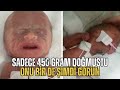 Sadece 450 Gram Doğan Kızı Hatırladınız mı? Onu Bir de Şimdi Görün.