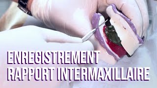 Tuto Prothèse Lenregistrement Du Rapport Intermaxillaire