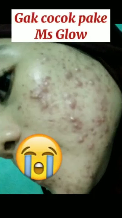 dari ms glow pindah ke solcare #shorts #acne #msglow #solcare.id #acnefighter