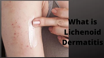 What is Lichenoid Dermatitis