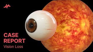 Painless Vision Loss - Case Report