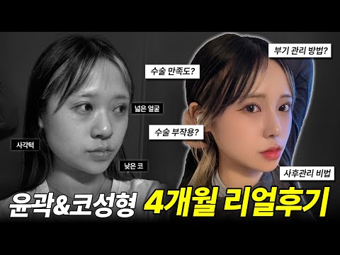 [성형브이로그] 안면윤곽수술+풀페이스지방이식+코성형후기