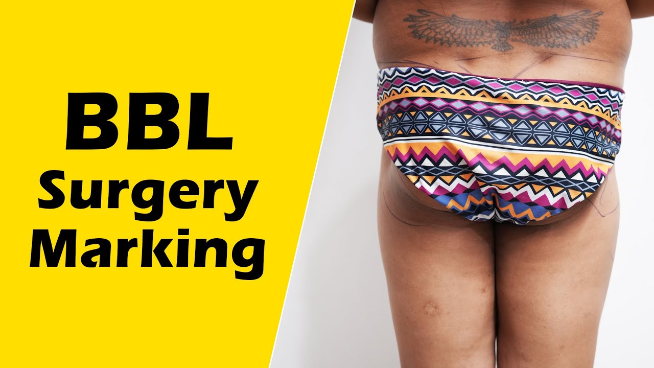 Brazilian Butt Lift  Lipoaesthetic Female