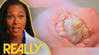 Doctor Has To Remove NAILS To Eradicate TUMORS | My Feet Are Killing Me