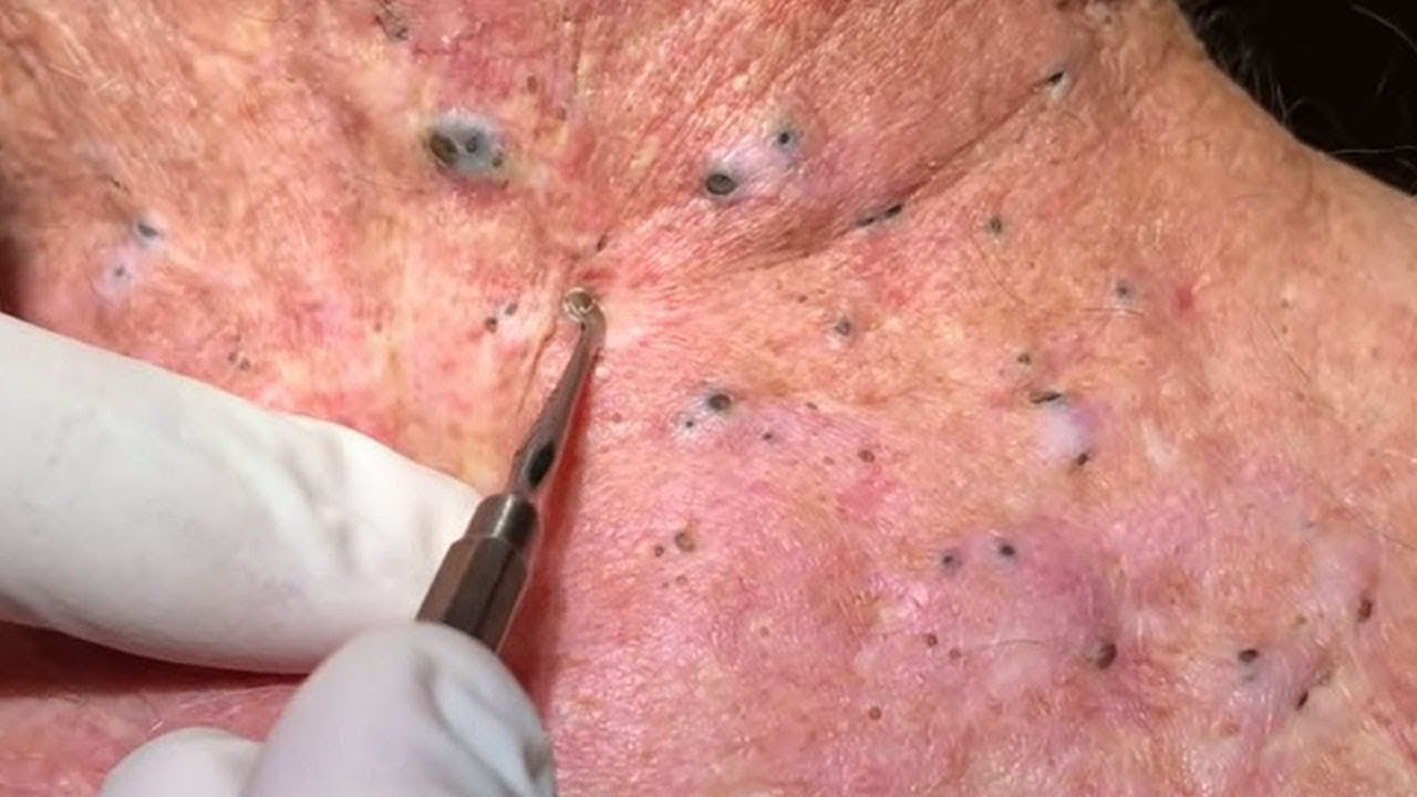 AWESOME EXTRACTION BLACKHEADS PART25 YouTube