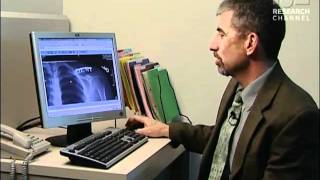 Collarbone Surgery - UW Medicine