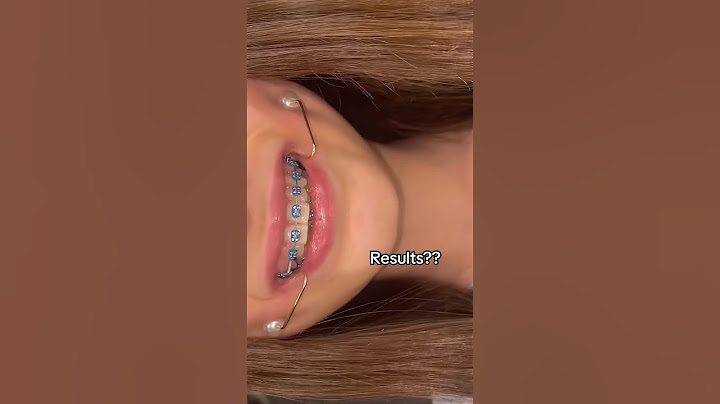 Can you Really Get Dimples Using THIS Device?! 🦷😬