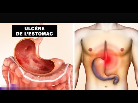 Vidéo: Gastroduodénite - Causes, Symptômes Et Traitement