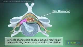 Cervical Spondylosis. Definition