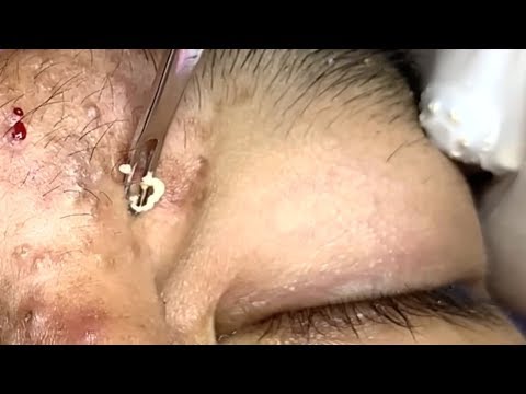 Blackhead Removable #ub [ ancy pimple  cleanser fda cystic acne extraction]