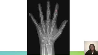 Hand X-ray Anatomy - ARRT