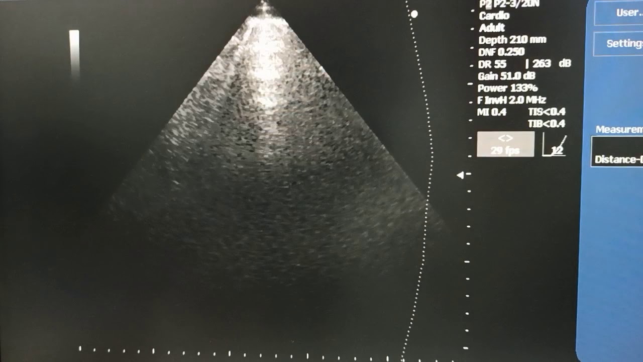 Миокардит Некомпактный миокард Тромбы Плевральный выпот Асцит - YouTube