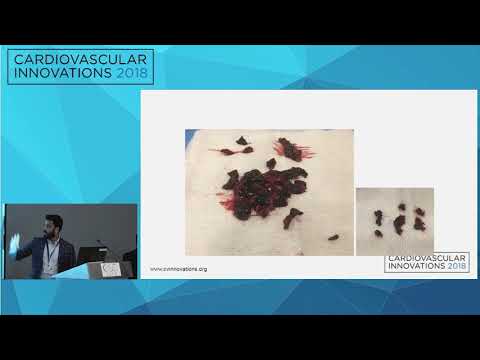 CVI2018: Mechanical & Aspiration Thrombectomy using Penumbra and Inari Devices