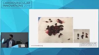 CVI2018 Session: Mechanical & Aspiration Thrombectomy using Penumbra and Inari Devices