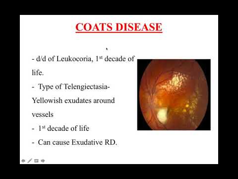 Video: Coats Disease: Behandlung, Stadien Und Symptome