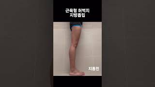 [지흡 당일-1일차] 근육형 허벅지, 지흡으로 허틈을 원한다!!  #브이로그 #지흡 #지흡후기
