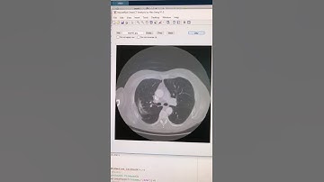 Real time Lung Nodule detection using chest CT slices with AI