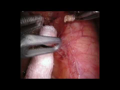 Robotic Left Upper Lobectomy - Most Difficult