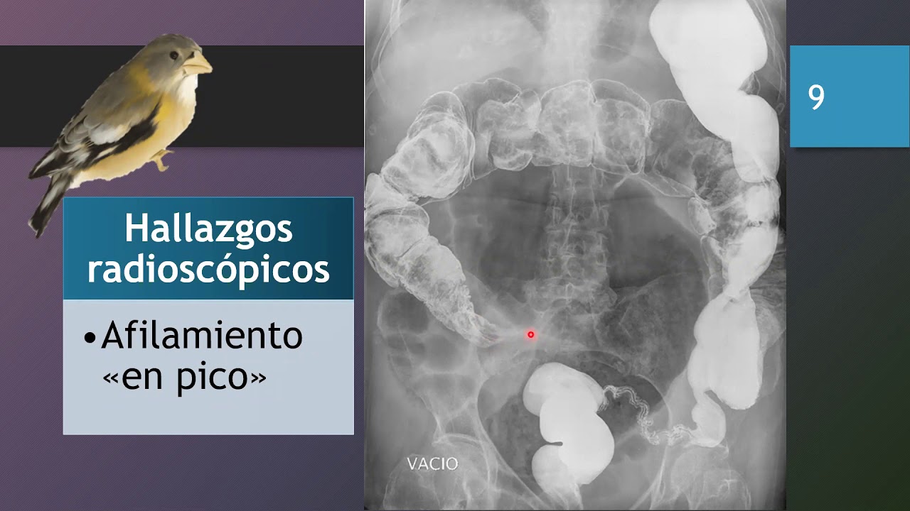PATOLOGÍA OBTRUCTIVA DE INTESTINO GRUESO
