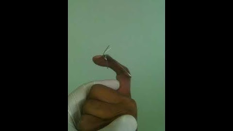 Finger external fixator with dynamic movement