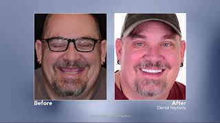 Replacing Missing Teeth with Dental Implants with Lafayette, Colorado dentist James Martin, DMD