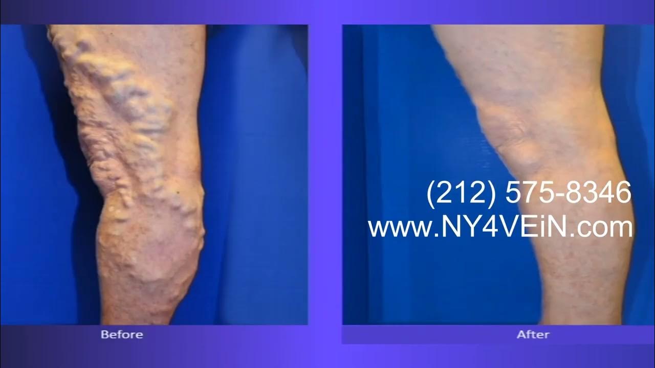 Best Varicose Veins Treatment For Legs Hands And Feet Before And After